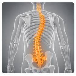 Scoliosis